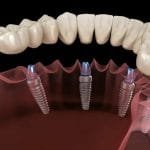 تجميل الأسنان في تركيا