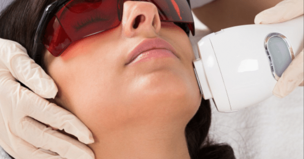 إزالة الشعر في المنزل بالليزر